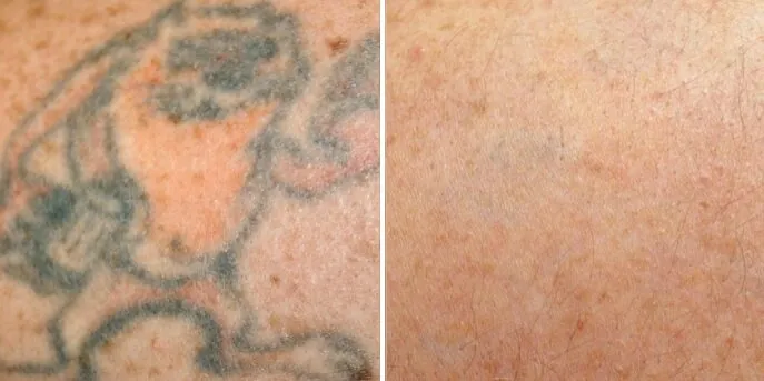 Before and after PicoSure Tattoo Removal, photo 2
