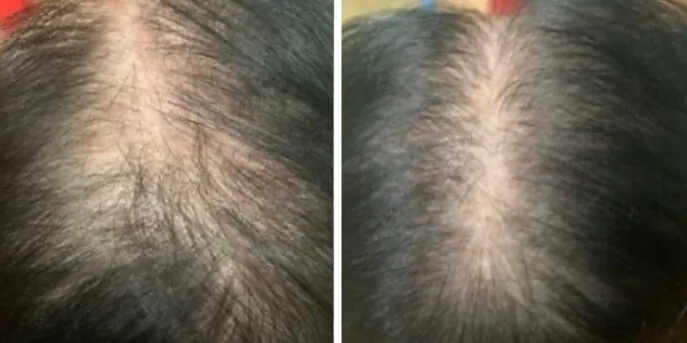 Before and after Pluryal Injections, photo 1