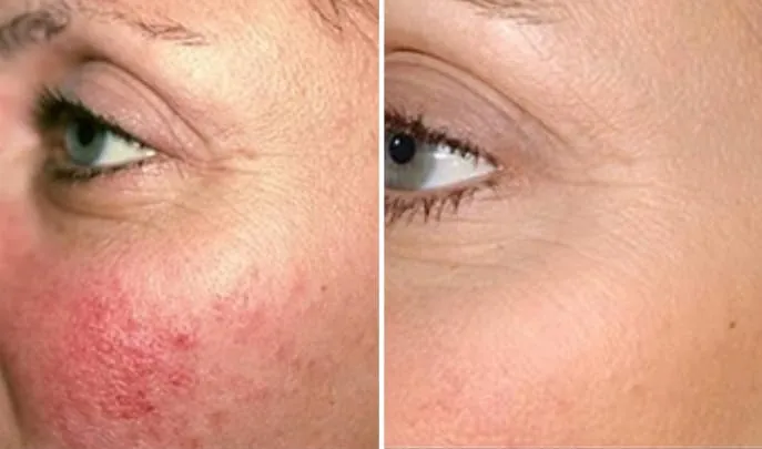 Before and after Laser Genesis, photo 3