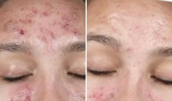 Before and after Chemical Peels, photo 2