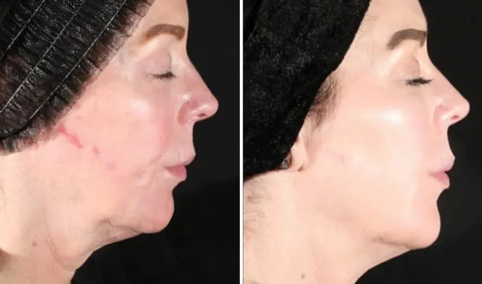 Before and after XERF Skin Tightening, photo 1