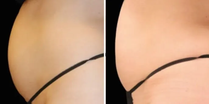 Before and after Emsculpt Neo, photo 2