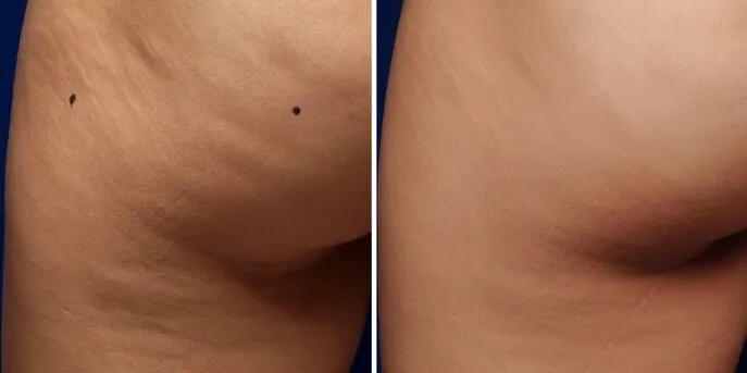 Before and after Body Skin Tightening, photo 3