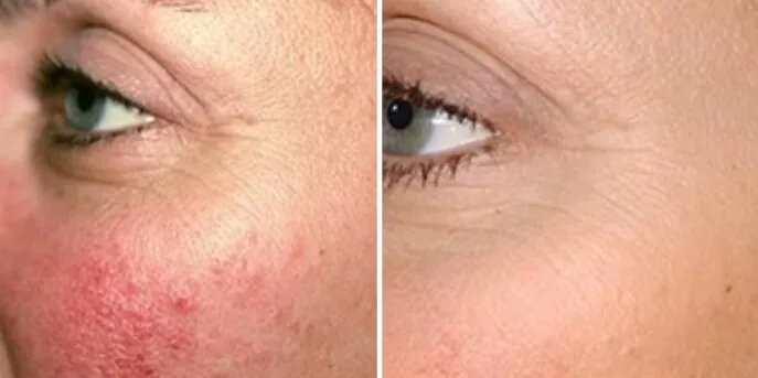 Before and after Rosacea & Redness Treatments, photo 2