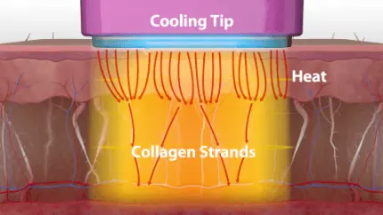 Body Skin Tightening: illustration 1