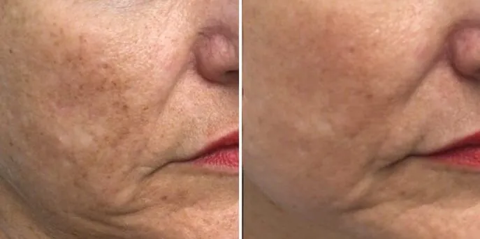 Before and after Morpheus8, photo 2