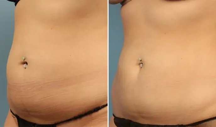 Before and after Evolve Transform, photo 2